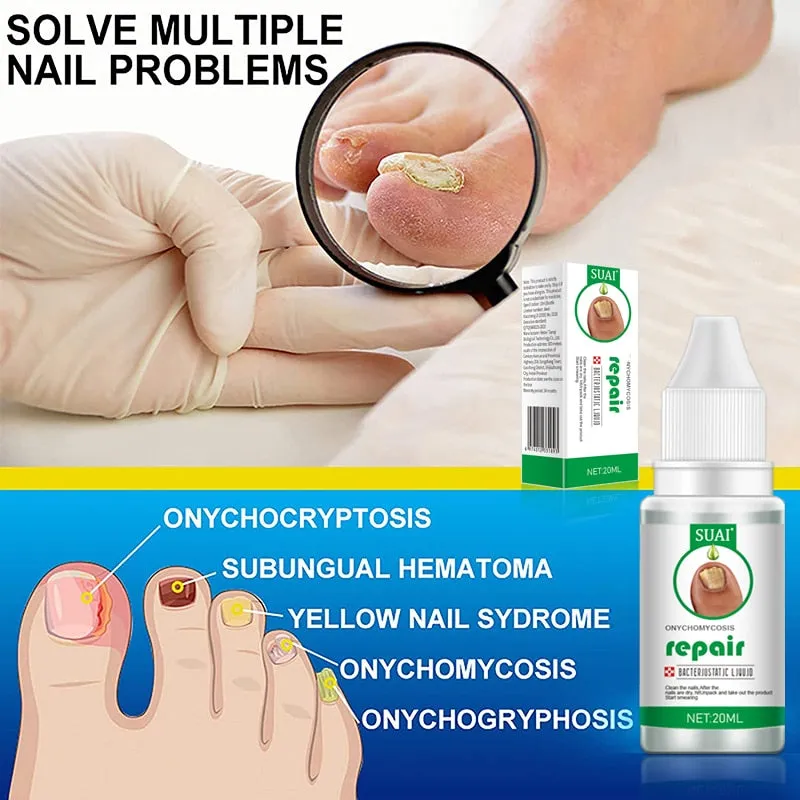 Nail Fungal Treatment Feet Care Essence Nail Foot Toe Nail Fungus Removal Gel Anti Infection Paronychia Onychomycosis