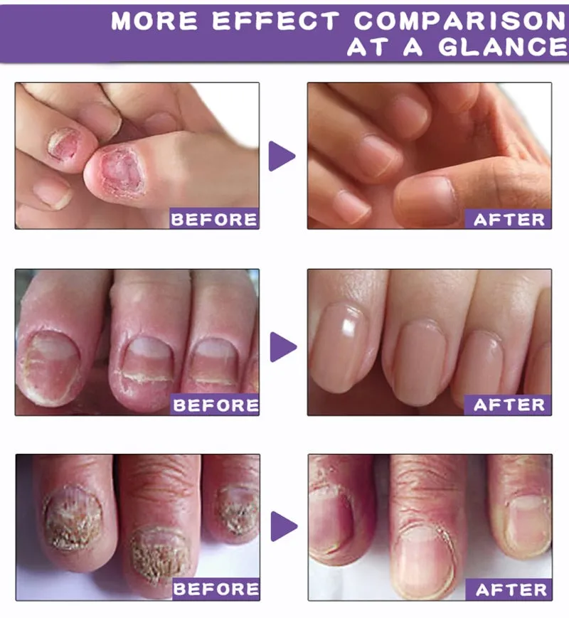 Nail Fungal Treatment Feet Care Essence Nail Foot Toe Nail Fungus Removal Gel Anti Infection Paronychia Onychomycosis